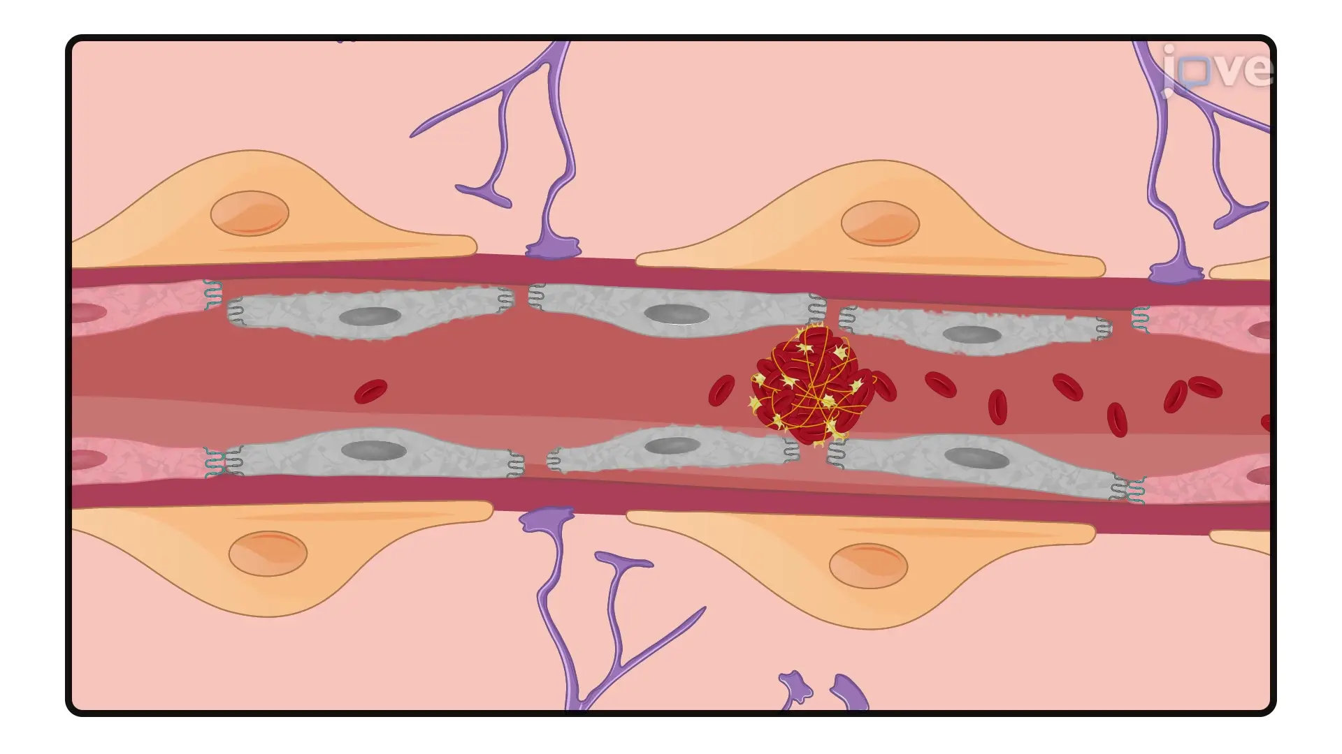 Modeling Photothrombotic Stroke in Mouse Model: A Laser Illumination Technique Through Mouse Skull Following Photosensitive Dye Administration to Induce Photothrombosis