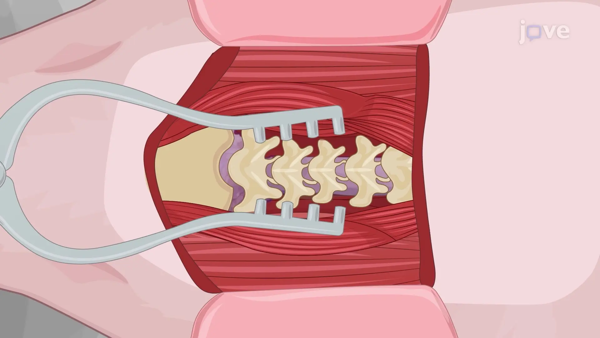 Locating the Cisterna Magna in a Pig Model: A Surgical Method to Access the Cisterna Magna in a Pig Model for Direct Cannulation