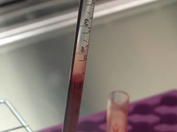 Rilevamento glicogeno in cellule periferiche mononucleate del sangue con Periodic Acid Schiff colorazione