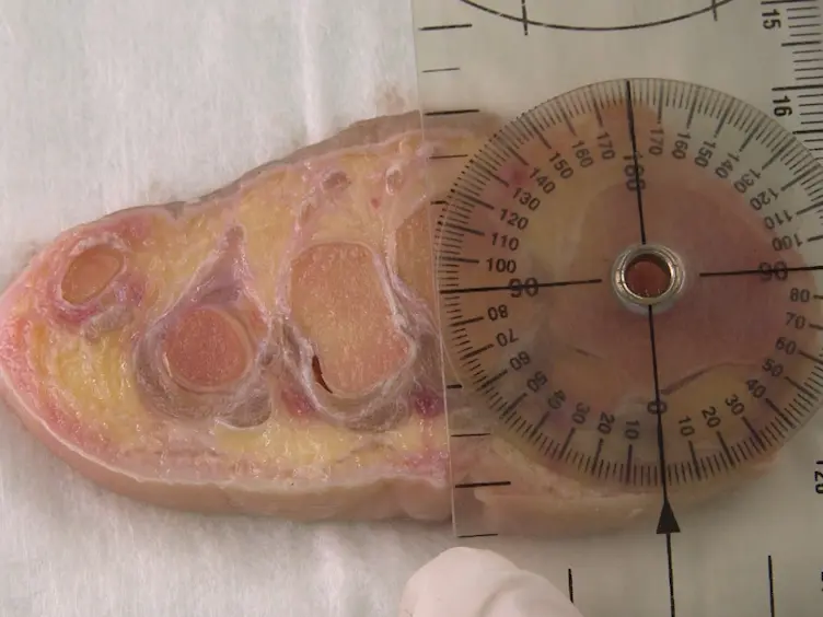 Une étude anatomique des nerfs à risque au cours de la mini-Invasive Hallux Valgus chirurgie