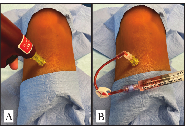 Creation of a High-Fidelity, Low-Cost, Intraosseous Line Placement Task ...