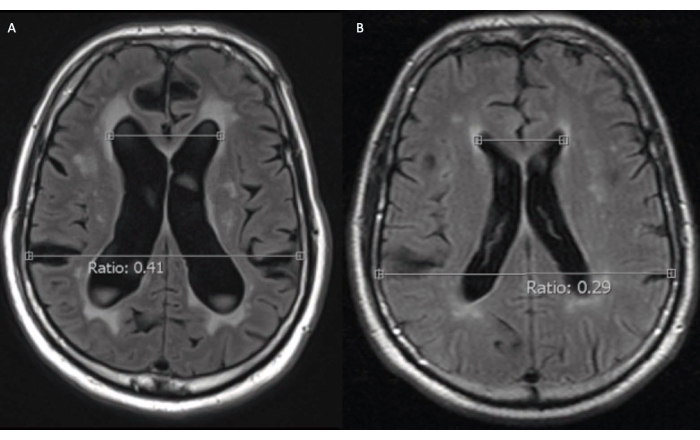 Neuronavigation and Laparoscopy Guided Ventriculoperitoneal Shunt ...