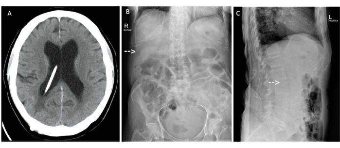 Neuronavigation and Laparoscopy Guided Ventriculoperitoneal Shunt ...