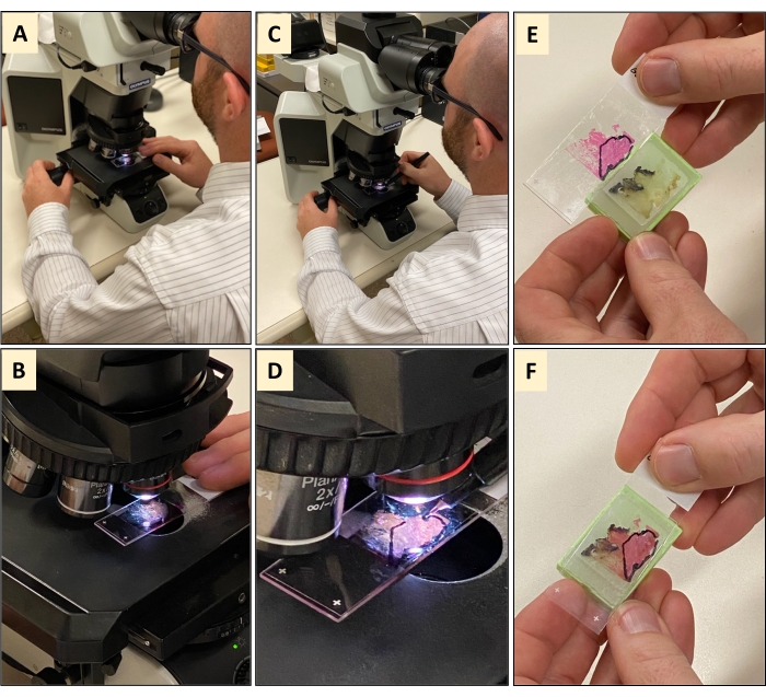 Enhancing Tumor Content through Tumor Macrodissection - JoVE