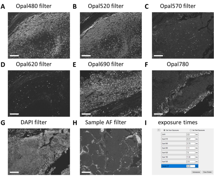 Multiplex Immunohistochemical Analysis of the Spatial Immune Cell ...