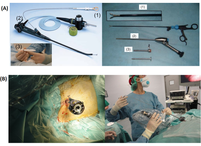 Toracoscopia in anestesia locale per versamento pleurico non diagnosticato