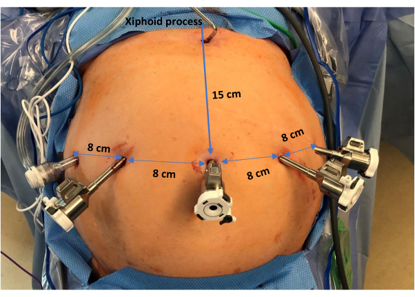 Robotic Heller Myotomy for Advancements in Surgical Management of ...