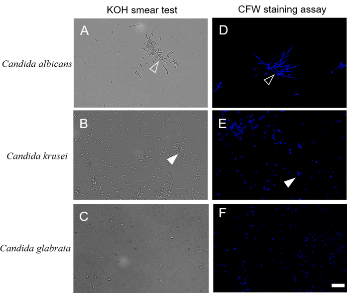 Examination of Oral Candida Infection in Primary Sjögren's Syndrome ...