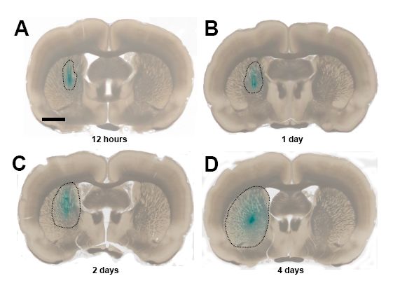 In vivo demonstation of sustained microinfusion of Fast Green. (A) Twelve hours after intrastriatal placement of a Fast Green-loaded microinfusion system, dye is seen diffusing into the parenchyma surrounding the microcannula site. Observations at 1 day (B), 2 days (C), and 4 days (D) indicate continued delivery of Fast Green solution with increasing areas of dye infiltration. The outer limit of diffusion was observed under low-power microscopy and is indicated here with dashed lines. Scale bar, 2 mm.